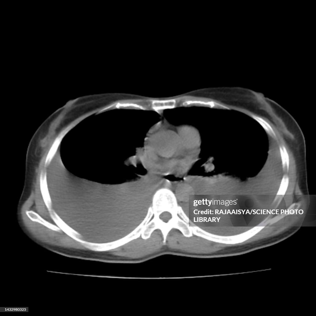 Pleural effusion, CT scan