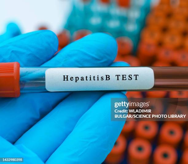 hepatitis b virus blood test, conceptual image - hepatite imagens e fotografias de stock