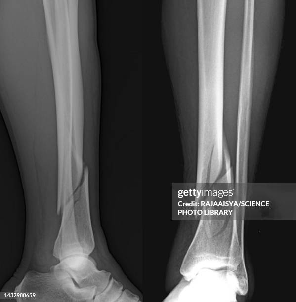 spiral fracture of the shin, x-rays - tibia stock pictures, royalty-free photos & images