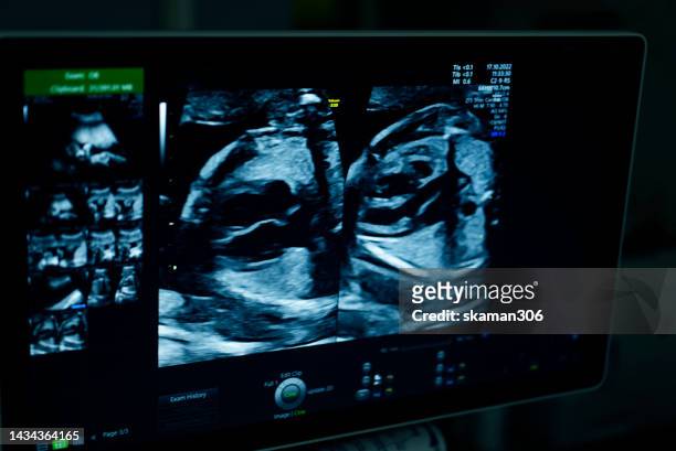 ultrasound sonogram of fetus 22 week pregnant - twin ultrasound stock pictures, royalty-free photos & images