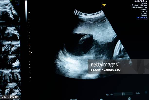 ultrasound sonogram of fetus 22 week pregnant - 3d mom son fotografías e imágenes de stock