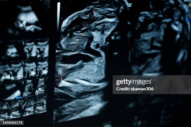 ultrasound sonogram of fetus 22 week pregnant - 20 week foetus stock pictures, royalty-free photos & images