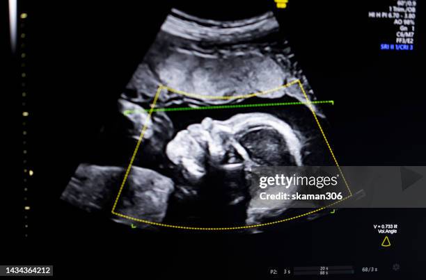 doctor used an ultrasound  3d sonogram  monitor for  the fetus 22 weeks young adult patient pregnant - looks of the week fotografías e imágenes de stock