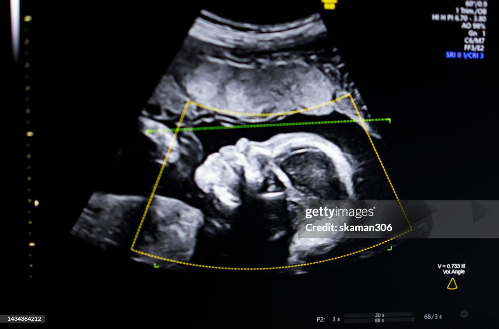 Doctor used an Ultrasound 3d sonogram monitor for the fetus 22 weeks young adult patient pregnant