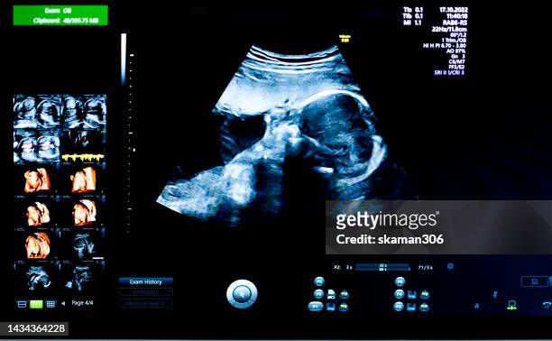 doctor used an ultrasound  3d sonogram  monitor for  the fetus 22 weeks young adult patient pregnant - human reproductive organ stock pictures, royalty-free photos & images