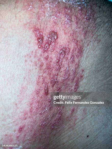 Zozster Rash 50 Herpes Zoster Rash Stock Photos, High-Res Pictures, and Images ...
