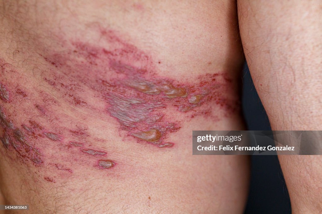 Diffuse Zoster Herpes Zoster High-Res Stock Photo - Getty Images