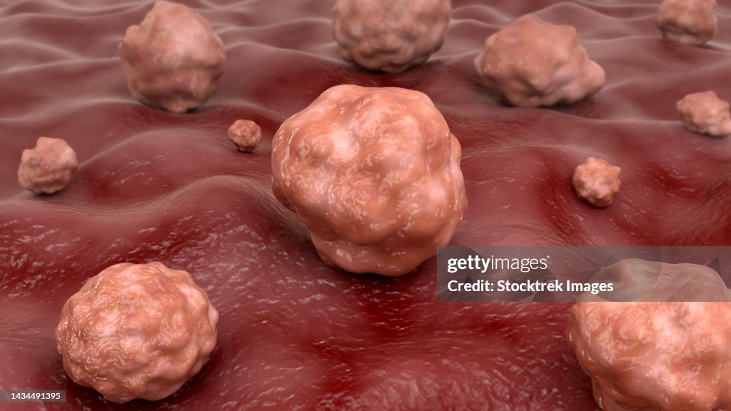 Conceptual biomedical illustration of the fungal infection, cryptococcosis