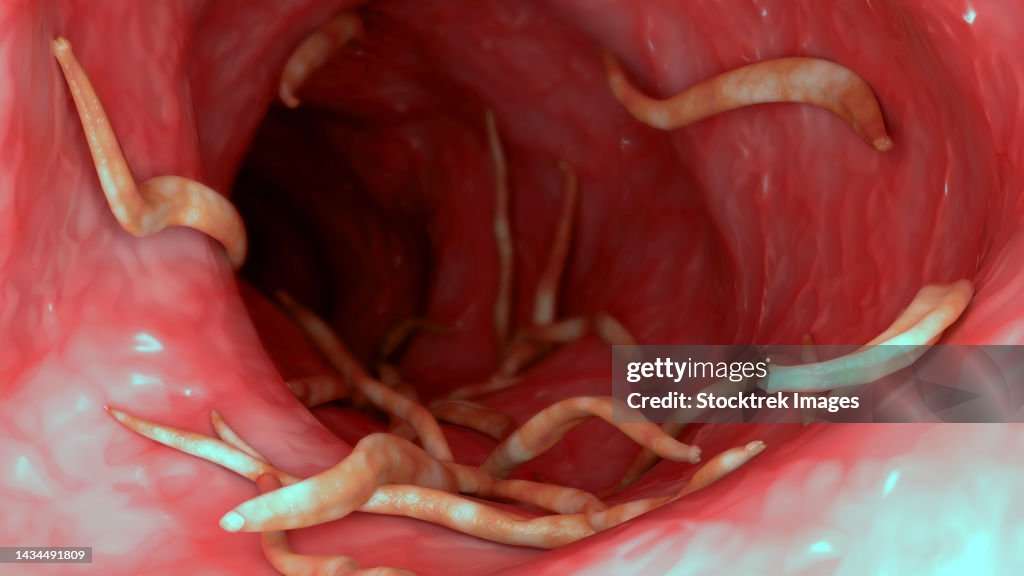 Conceptual biomedical illustration of Ascaris lumbricoides in the human intestines