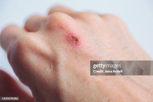 healing scab closeup skin injury on hand - hand laceration stock pictures, royalty-free photos & images