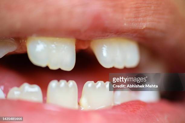 uneven teeth of child - uneven stock pictures, royalty-free photos & images