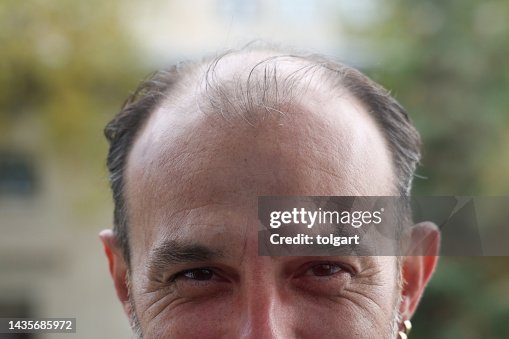 Bald head problem Bald head problem