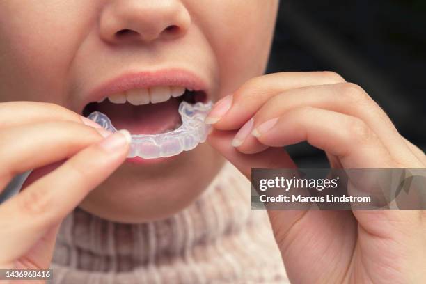 teenage girl with plastic braces to use on her teeth - invisible braces stock pictures, royalty-free photos & images