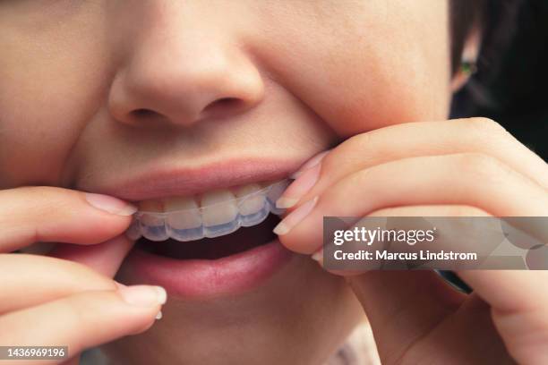 teenage girl using plastic braces - aparelho dentário imagens e fotografias de stock