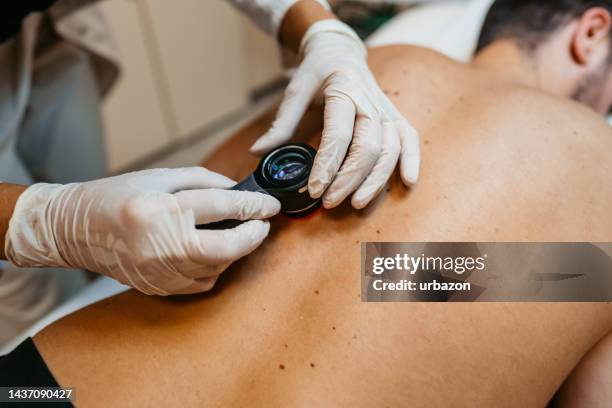 female doctor examining patients birthmarks - mole stockfoto's en -beelden