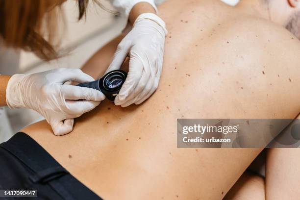 female doctor examining patients birthmarks - mole skin stock pictures, royalty-free photos & images