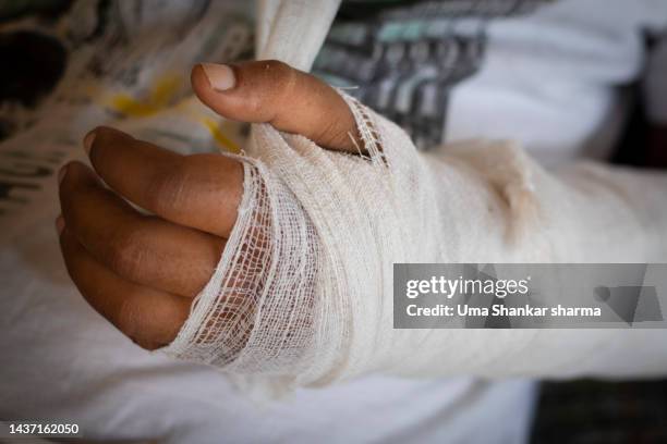 broken arm in orthopedic cast - knochenbruch stock-fotos und bilder