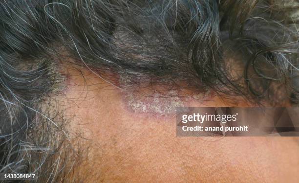 seborrheic dermatitis - seborrheic dermatitis stock pictures, royalty-free photos & images