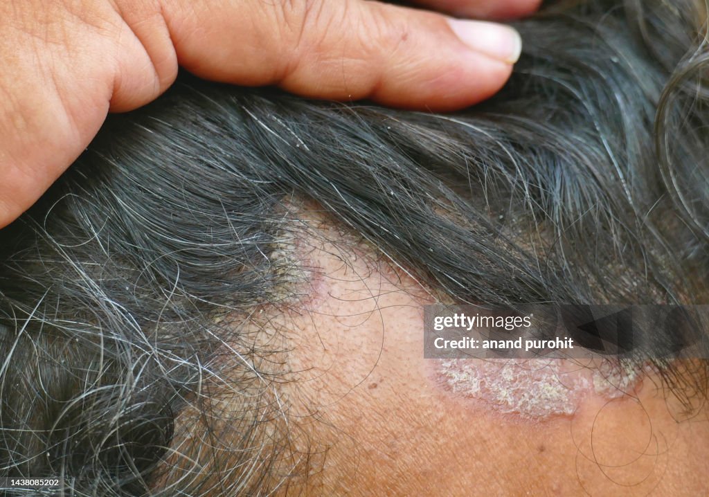 Seborrheic Dermatitis High Res Stock Photo Getty Images seborrheic-dermatitis-high-res-stock-photo-getty-images