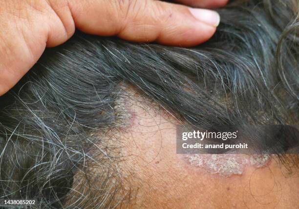 seborrheic dermatitis - seborrheic dermatitis stock pictures, royalty-free photos & images