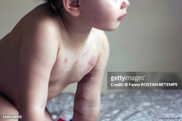 burned child scars portrait - queimadura pele - fotografias e filmes do acervo