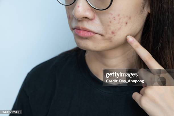 cropped shot of woman pointing to an acne problem on her cheek. - blackheads photos et images de collection