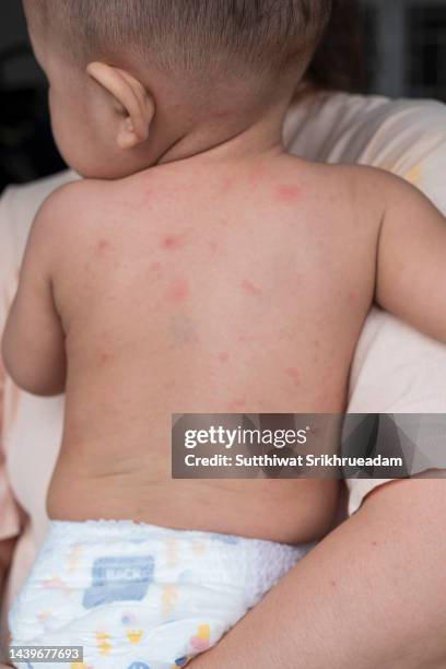 Baby Rashes Back Baby Skin Rash Photos and Premium High Res Pictures - Getty Images
