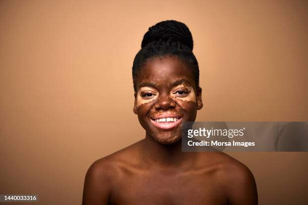 6 893 photos et images de Vitiligo - Getty Images