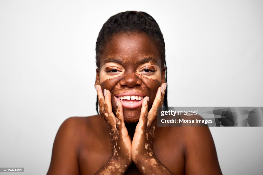 Portrait of Beautiful African American Young Woman with Vitiligo against White Background.