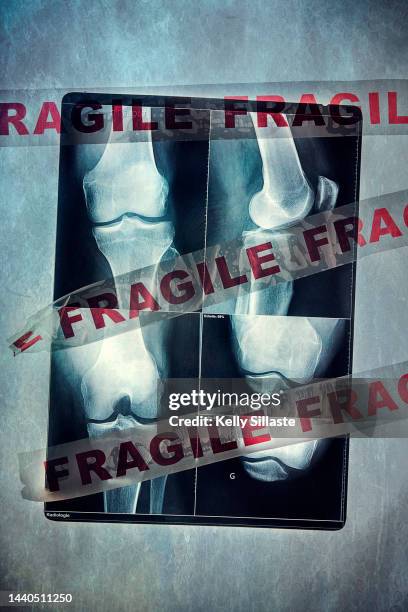 x-ray image with fragile tape - femur fotografías e imágenes de stock