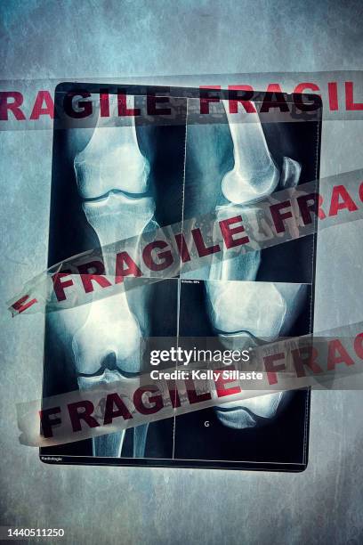 x-ray image with fragile tape - fragility fracture stock pictures, royalty-free photos & images