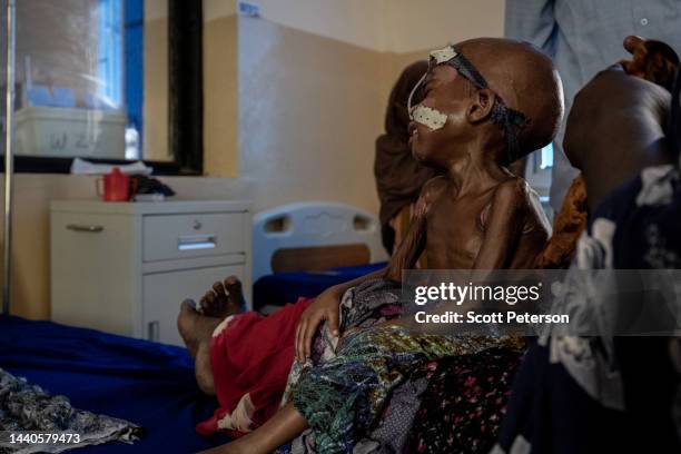 Severely malnourished Somali girl Sumaya Keerow Abduram cries at the Banadir Maternity and Childrens Hospital, as Somalis struggle to cope with...