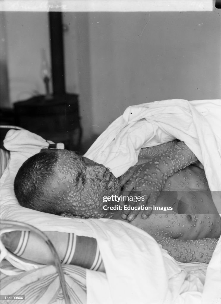 Smallpox Victim Between 1898 And 1946.