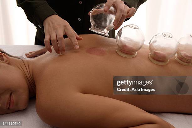 therapist removing cups from suction treatment - cupping stockfoto's en -beelden