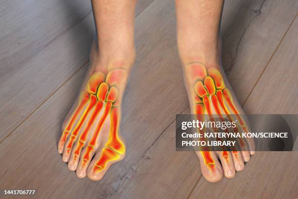 bunion, illustration - hallux valgus stock illustrations