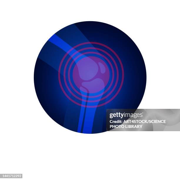 knee joint pain, conceptual illustration - meniscus stock illustrations