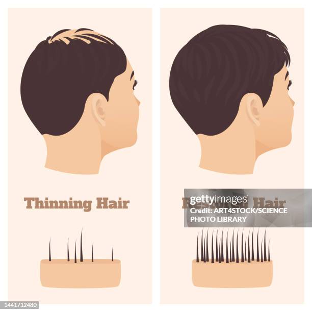 ilustraciones, imágenes clip art, dibujos animados e iconos de stock de alopecia in women, conceptual illustration - human scalp