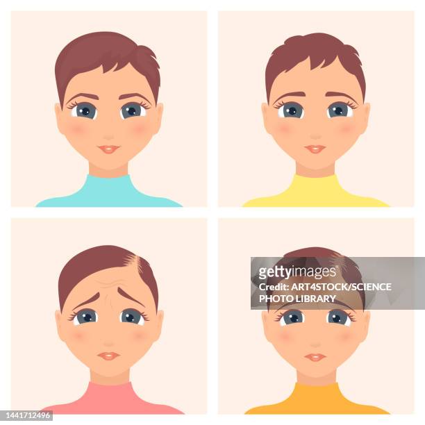 female alopecia stages, illustration - adult stock illustrations点のイラスト素材／クリップアート素材／マンガ素材／アイコン素材