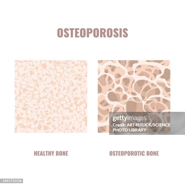 osteoporosis, conceptual illustration - osteoporose stock-grafiken, -clipart, -cartoons und -symbole