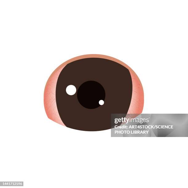 stockillustraties, clipart, cartoons en iconen met conjunctivitis, conceptual illustration - hordeolum