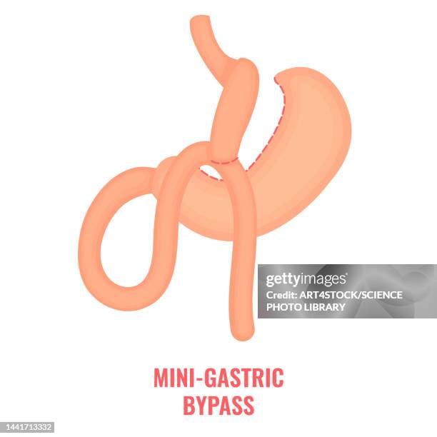 mini gastric bypass bariatric surgery, illustration - 内視鏡点のイラスト素材／クリップアート素材／マンガ素材／アイコン素材