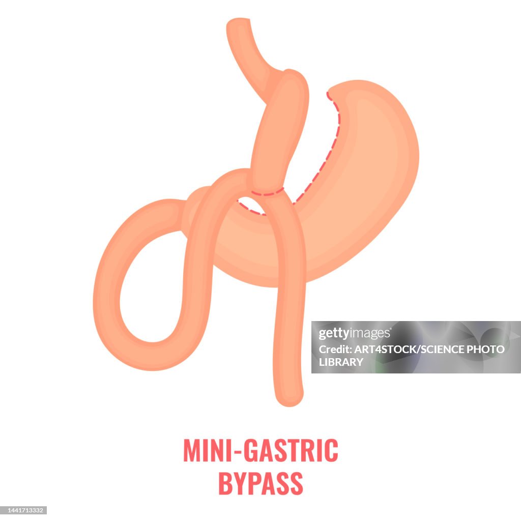 Mini gastric bypass bariatric surgery, illustration