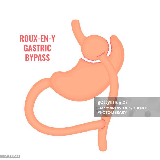 ilustrações, clipart, desenhos animados e ícones de roux-en-y gastric bypass bariatric surgery, illustration - jejuno