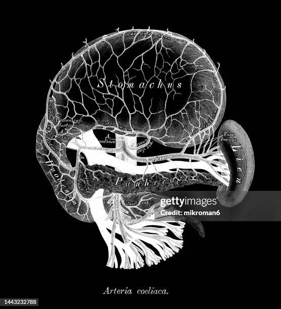 Angiogram Labeled Trunk Celiac Trunk Angiogram