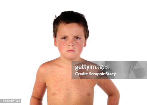 Boy Rash Back A Sick Young Boy With A Red Rash All Over His Face And Body High-Res ...