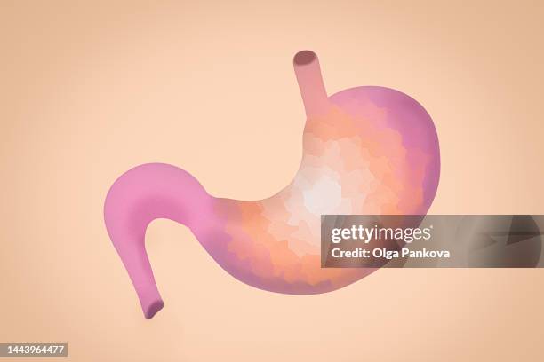 gastroenterology illustration, human stomach - ulcera foto e immagini stock