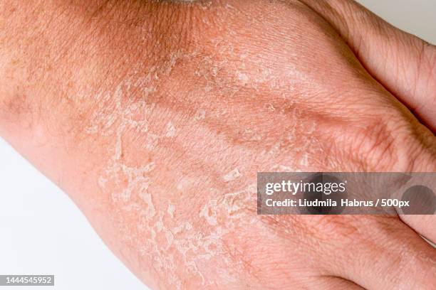 skin peels off the hand after a sunburn close-up isolate - sun blistered stock pictures, royalty-free photos & images