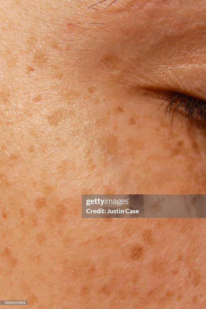 Freckled face detail