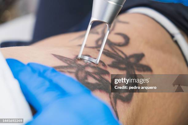 laser tattoo removal - removing fotografías e imágenes de stock