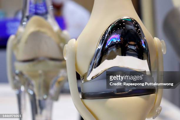 artificial joint implants of metal and plastic - knee replacement surgery stock pictures, royalty-free photos & images